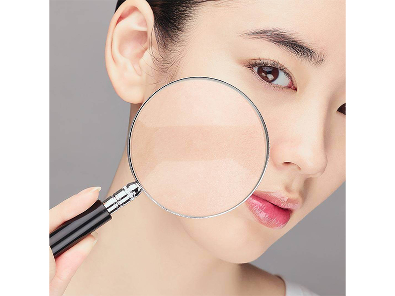 Những cách trị thâm mụn trả lại cho bạn làn da trắng hồng rạng rỡ