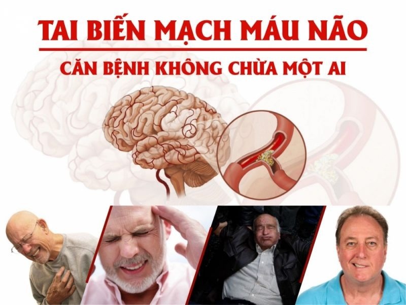 Bệnh tai biến mạch máu não là gì?