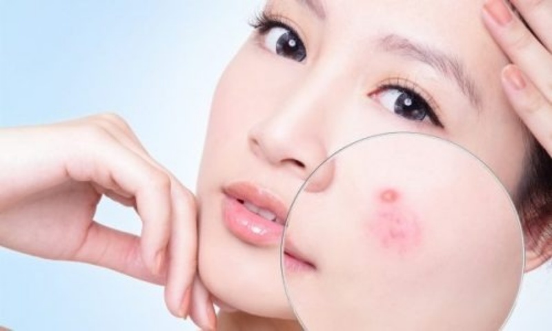 Hiện tượng nổi mụn sau khi uống Collagen