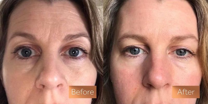 Hình ảnh trước và sau khi sử dụng Collagen cho cơ thể