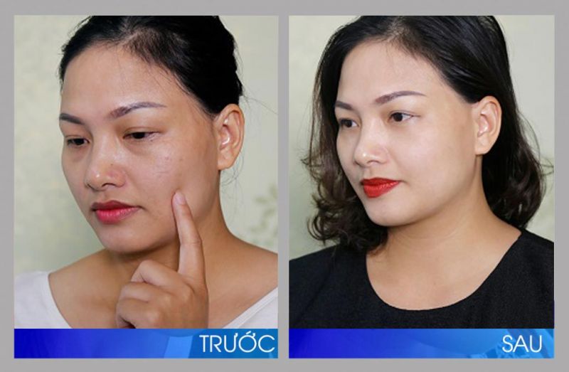 Hình ảnh về trước và sau khi sử dụng Collagen
