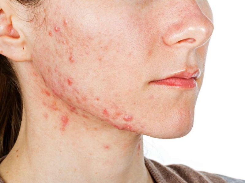 ÁNH NẮNG MẶT TRỜI LÀ NGUYÊN NHÂN GÂY MỤN 
