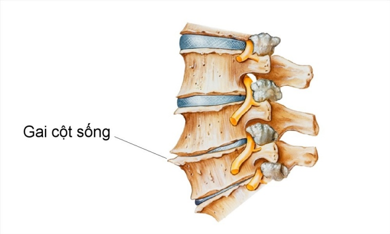 GAI CỘT SỐNG LƯNG