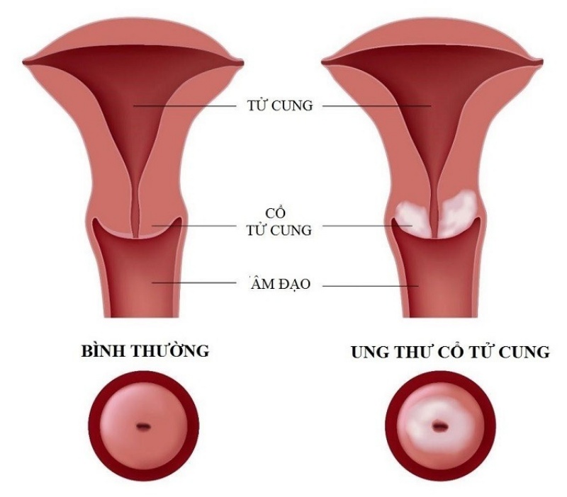 UNG THƯ CỔ TỬ CUNG