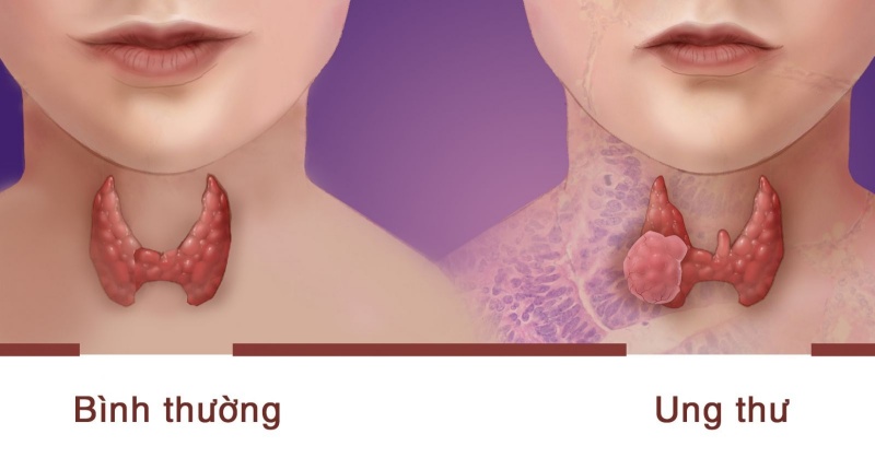 UNG THƯ TUYẾN GIÁP