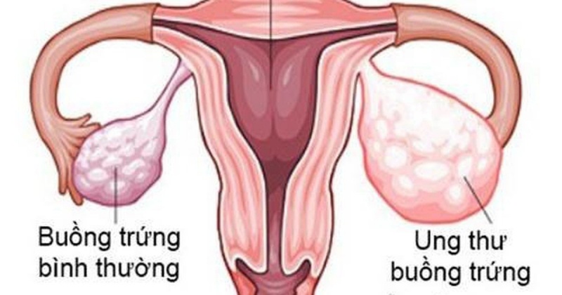 UNG THƯ BUỒNG TRỨNG