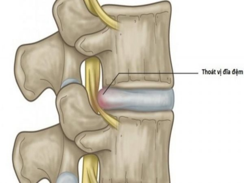 Thoát vị đĩa đệm