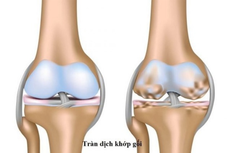 Tràn dịch khớp gối làm khớp gối sưng và đau nhức