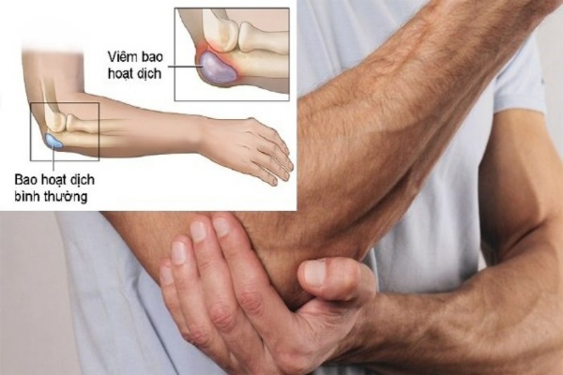 Viêm bao hoạt dịch thường gặp ở người lớn tuổi hoặc người làm một công việc lặp đi lặp lại
