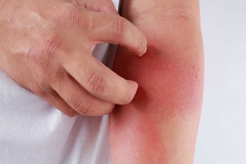 Người bệnh cần nghỉ ngơi, sinh hoạt hợp lý để phòng ngừa viêm bao hoạt dịch