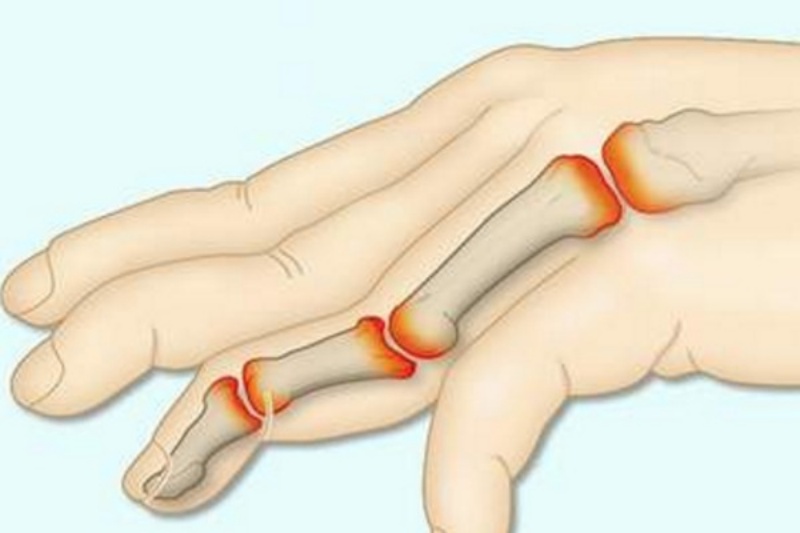 Thoái hóa khớp tay gây đau đớn, khó chịu và ảnh hưởng tới cuộc sống hằng ngày của người bệnh
