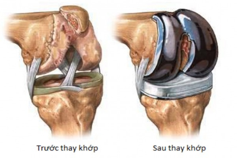 Tầm quan trọng của vật lý trị liệu sau phẫu thuật thay khớp gối