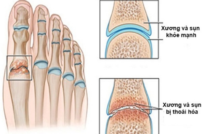Thoái hóa khớp bàn ngón chân có thể gây ra tàn phế