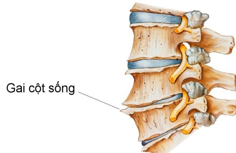 Tổng quan bệnh Gai cột sống
