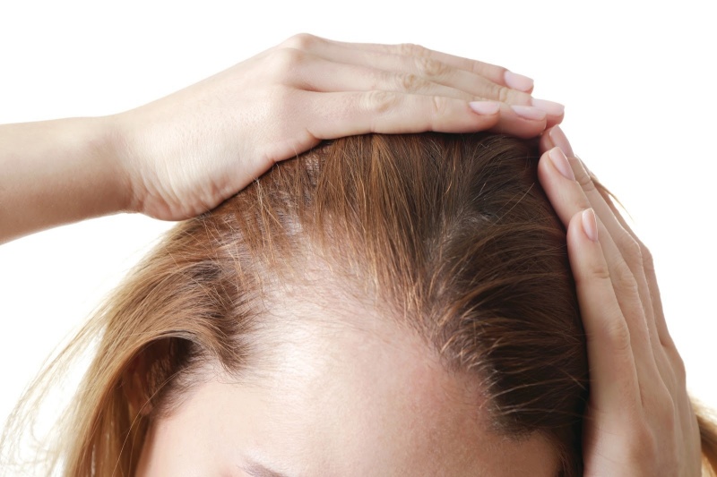 Rụng tóc nhiều có thể cơ thể mắc bệnh lý