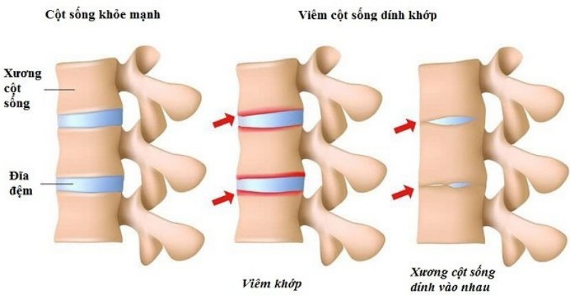 Viêm cột sống dính khớp là gì?