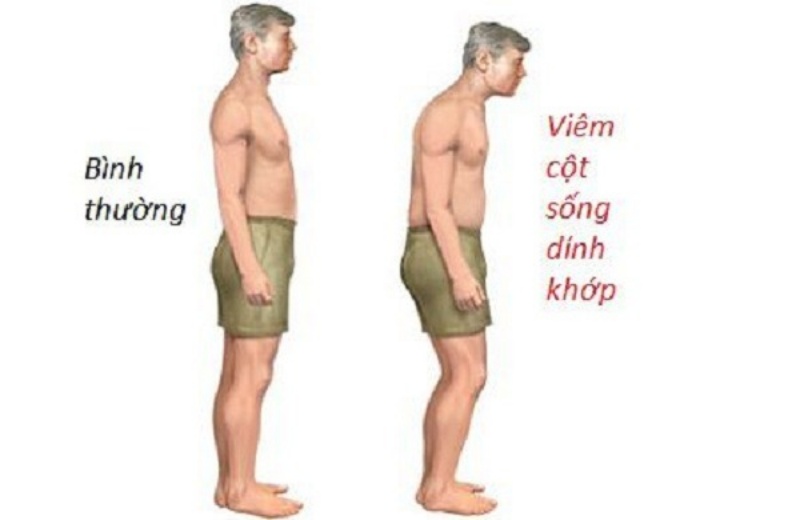 Đối tượng có nguy cơ cao mắc viêm cột sống dính khớp