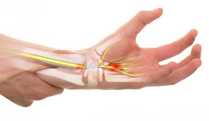 Đừng nên xem thường bệnh viêm khớp vùng cổ tay