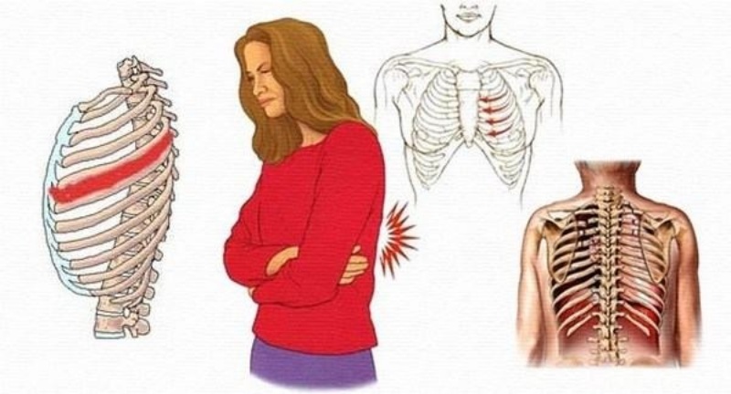 Đừng chủ quan khi bị đau xương sườn