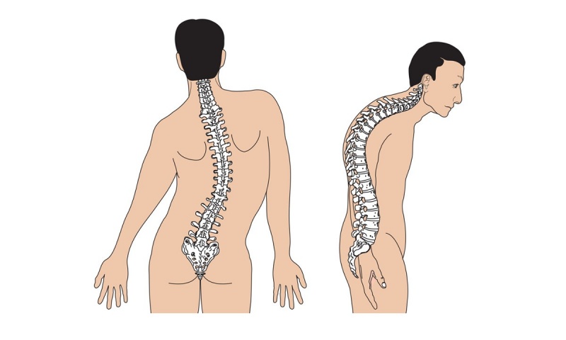 5 bệnh lý nguy hiểm thường gặp ở cột sống