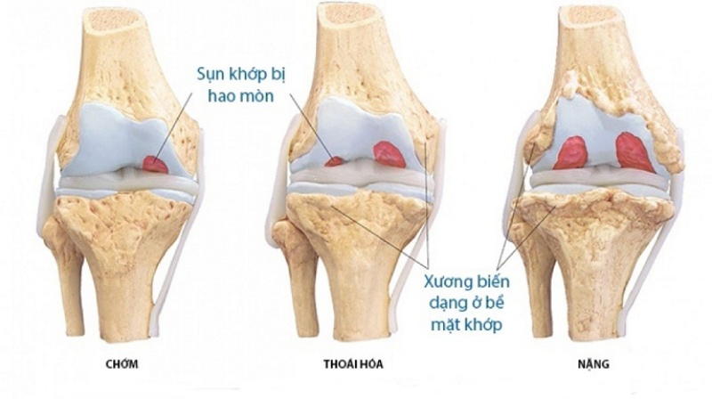 Sụn và xương dưới sụn hư hại dẫn đến thoái hóa khớp