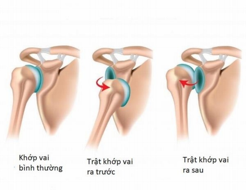 Khớp vai là khớp di động nhất của cơ thể, vì thế rất dễ bị trật