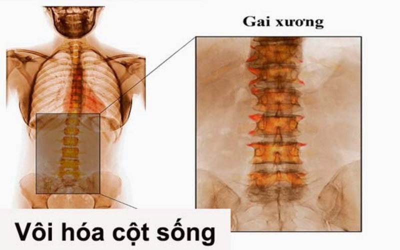 Cách khắc phục vôi hóa cột sống