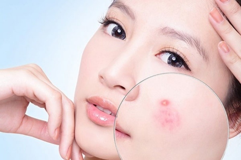 Nổi mụn là một trong những tác dụng phụ khi sử dụng collagen có chất lượng kém hoặc lạm dụng quá đà