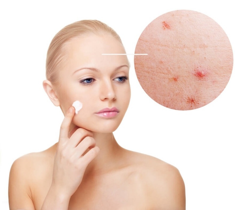 Sử dụng collagen có gây mụn không?