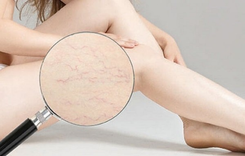 Rạn da khiến nhiều chị em mất đi sự tự tin
