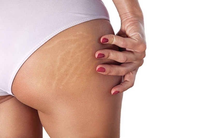 Rạn da mông là tình trạng thường gặp ở chị em phái đẹp
