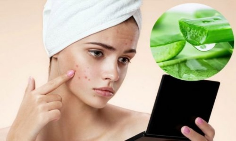 Làm dịu da mụn tuổi 30 với nha đam đơn giản hiệu quả tại nhà