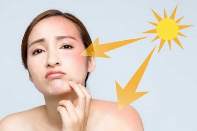 Tại sao tiếp xúc nhiều với ánh nắng mặt trời lại dẫn tới da bị nám nắng?