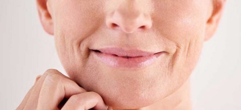 Thiếu hụt collagen là một trong những nguyên nhân xuất hiện rãnh cười tuổi 30