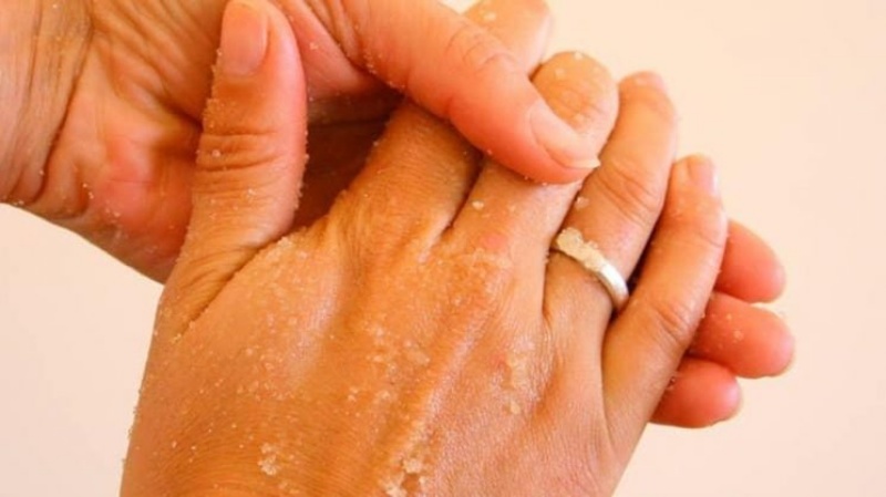 Đối với các loại nám da tay nhẹ, vừa mới xuất hiện loại bỏ sẽ đơn giản hơn