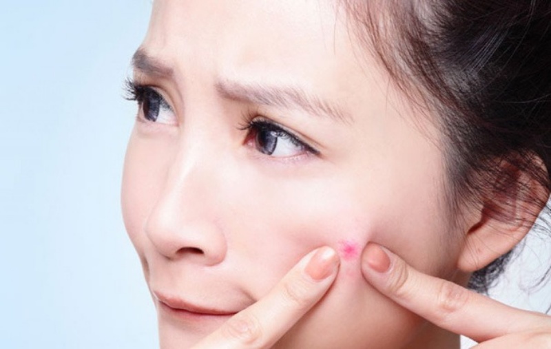  Không nên tự ý nặn mụn vì có thể gây viêm nhiễm, làm tình trạng mụn tệ hơn