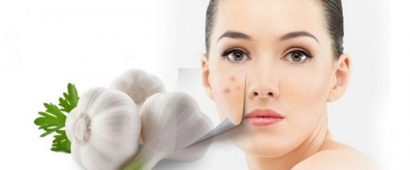 Trị mụn viêm bằng tỏi sống là phương pháp được nhiều người áp dụng