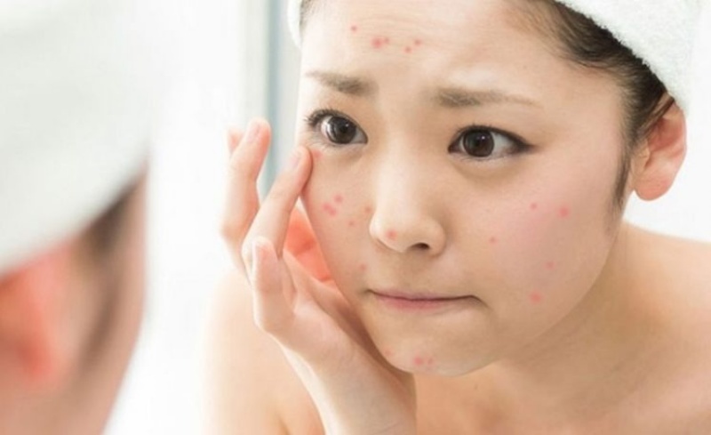 Cần lưu ý khi chăm sóc da mụn viêm ở tuổi 30 tại nhà