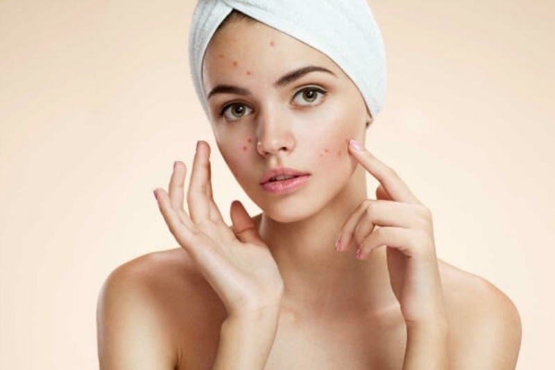 Tẩy da chết giúp ngăn ngừa sự xuất hiện của mụn
