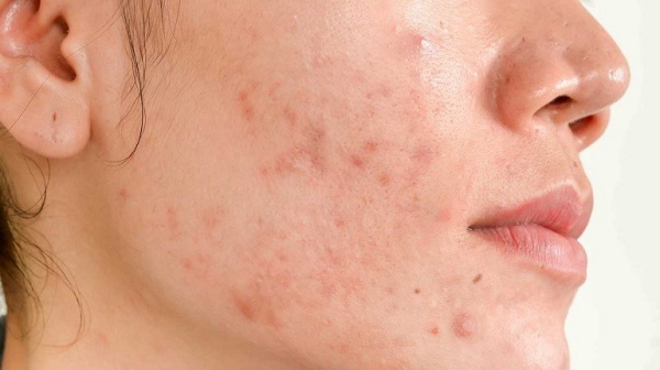 Những nguyên nhân phổ biến nhất gây ra sẹo thâm