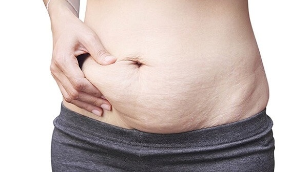 Tình trạng bùng chảy xệ, chùng nhão khiến chị em cảm thấy thiếu tự tin trong cuộc sống