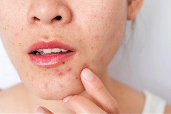 Sẹo thâm hình thành trên mặt do đâu?