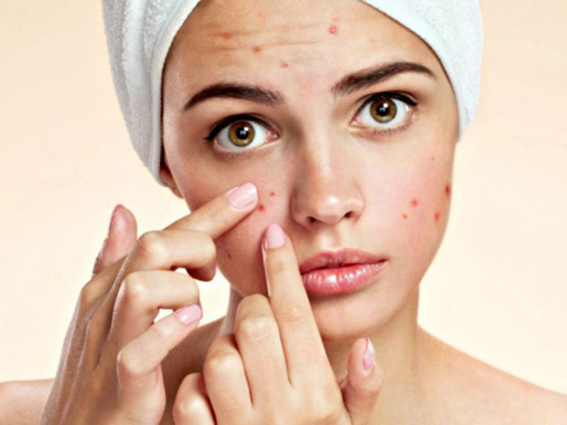 Tình trạng da mụn gây ảnh hưởng đến làn da và sức khỏe 