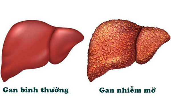 gan-nhiem-mo