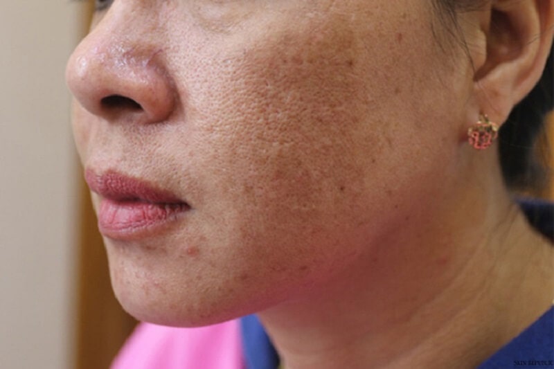 Nám hỗn hợp