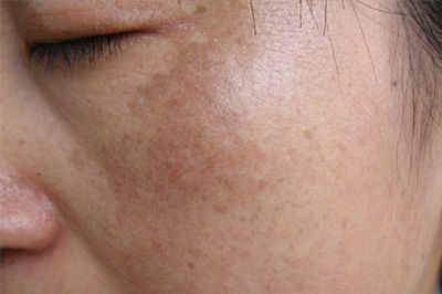 Phân biệt nám, tàn nhang, đồi mồi