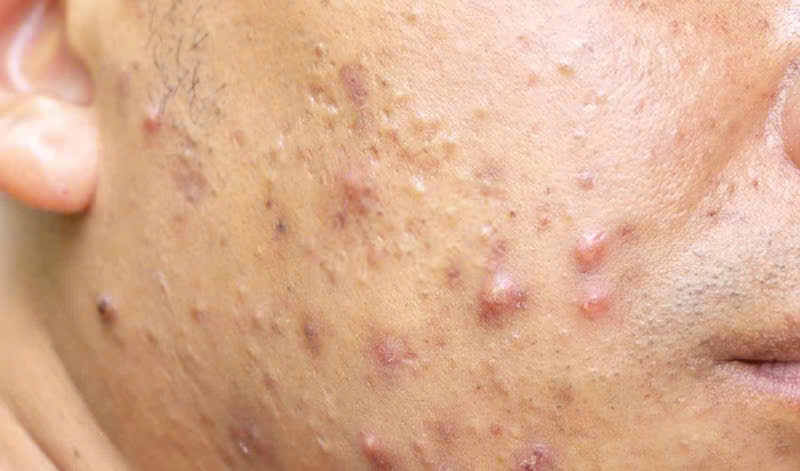 Mụn trứng cá xuất hiện nhiều
