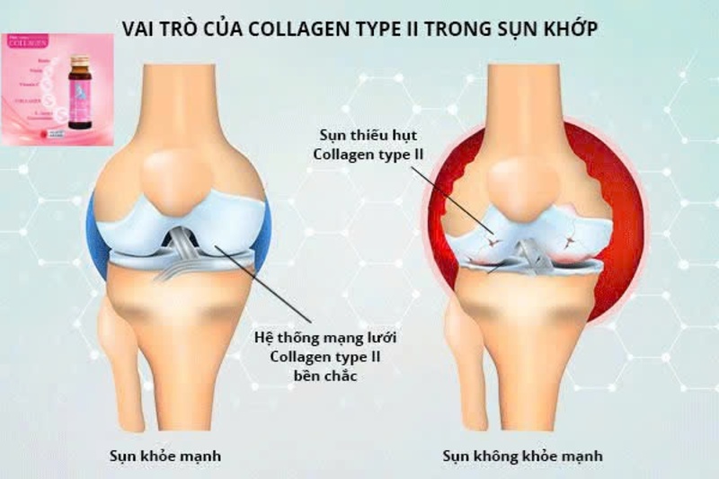 Dấu hiệu thiếu hụt collagen ở phụ nữ tuổi 35 - xương khớp thoái hóa