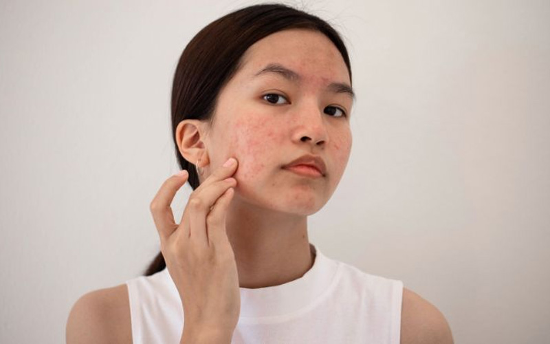 Da bắt đầu nổi mụn