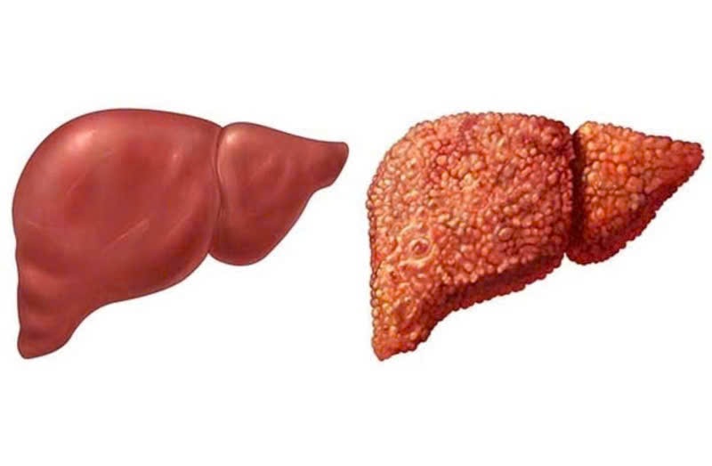 Các nguyên nhân gây bệnh lý về gan